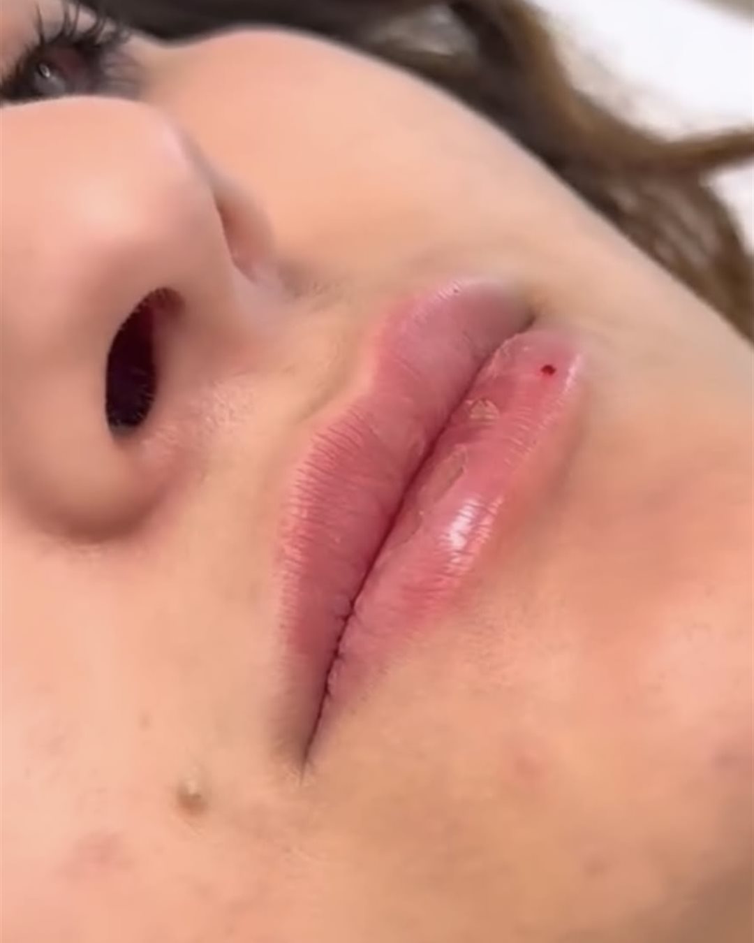 עיצוב שפתיים לפני ואחרי - מרום מדיקל קליניק בני ברק (6)