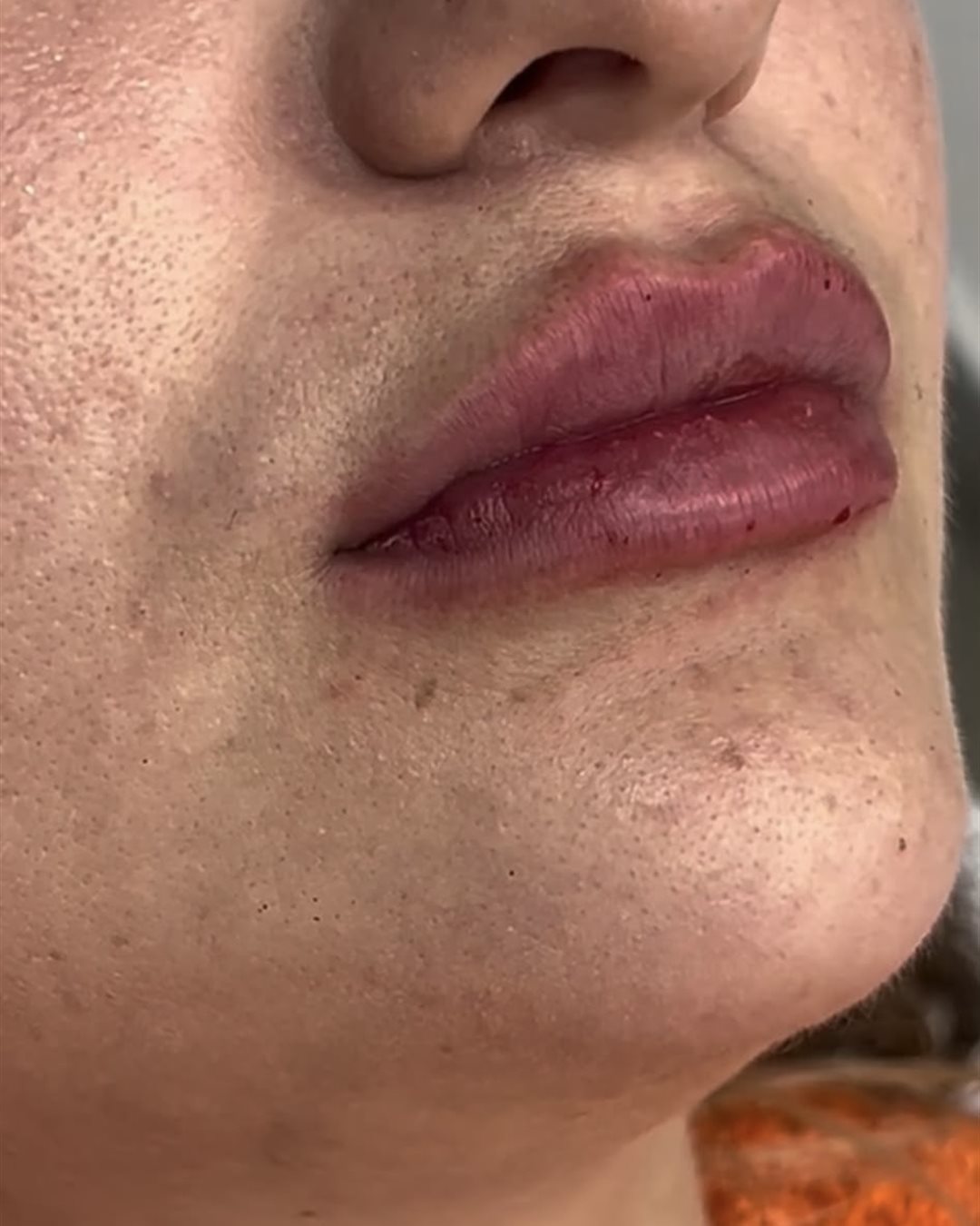 עיצוב שפתיים לפני ואחרי - מרום מדיקל קליניק בני ברק (7)